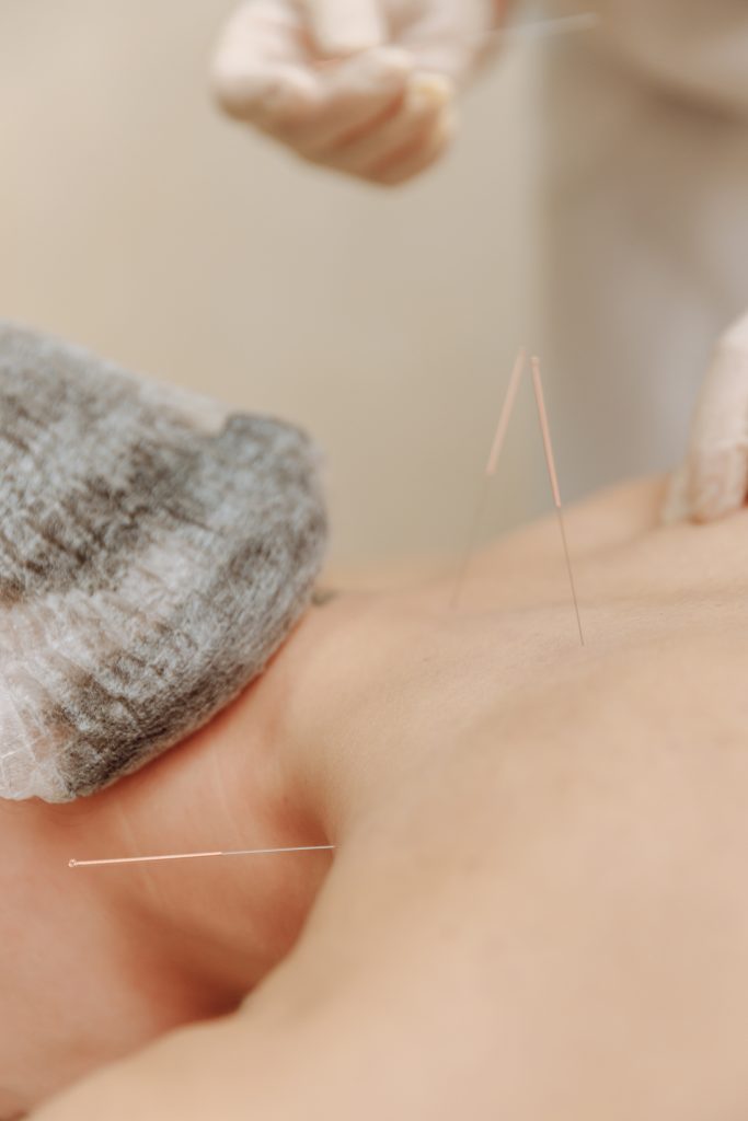 Woman receiving acupuncture services.