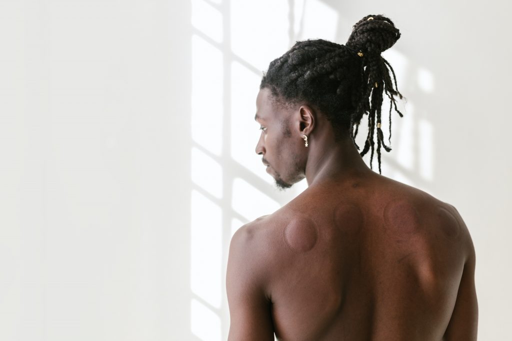 Man with cupping marks on his back.